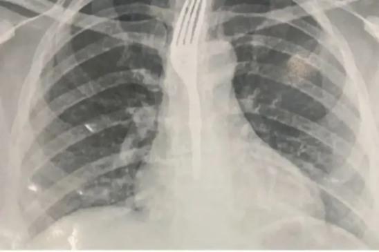 Mulher engole garfo durante refeição; caso inusitado foi registrado no sudoeste baiano